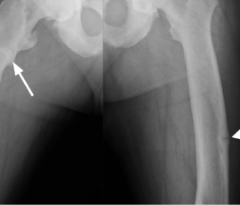 X-ray of legs with pseudofractures