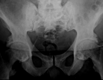 x-ray of hip