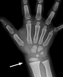 x-ray of hand