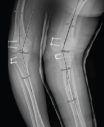 x-ray of leg