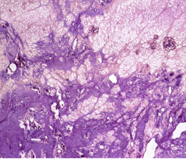 visual of osteomalacia