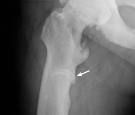 pseudofracture visual